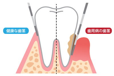 歯周病は歯並び・噛み合わせの悪化にもつながります
