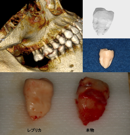 自家歯牙移植①｜西川口の歯医者・歯科「ハートピアデンタルオフィス